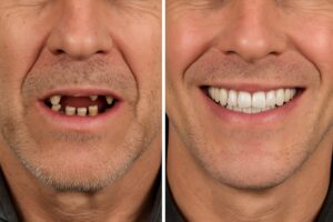A before-and-after image showcasing a patient's smile transformation with "all new teeth." The "before" side shows damaged or missing teeth, while the "after" side features a complete, natural-looking set of teeth. No text on image.
